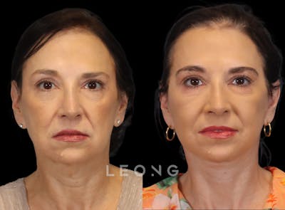 Facelift Before & After Gallery - Patient 235559 - Image 1