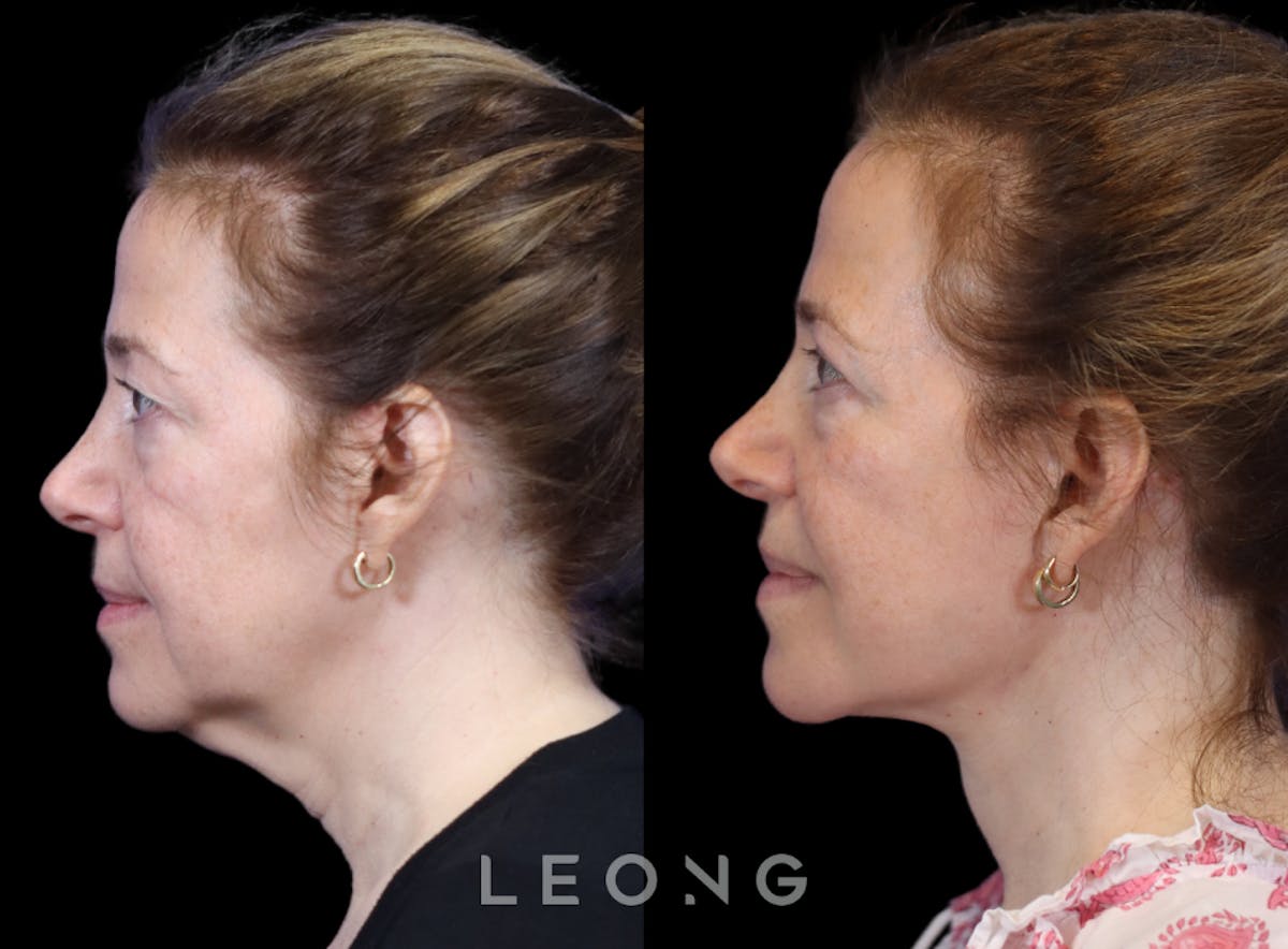 Facelift Before & After Gallery - Patient 495050 - Image 7