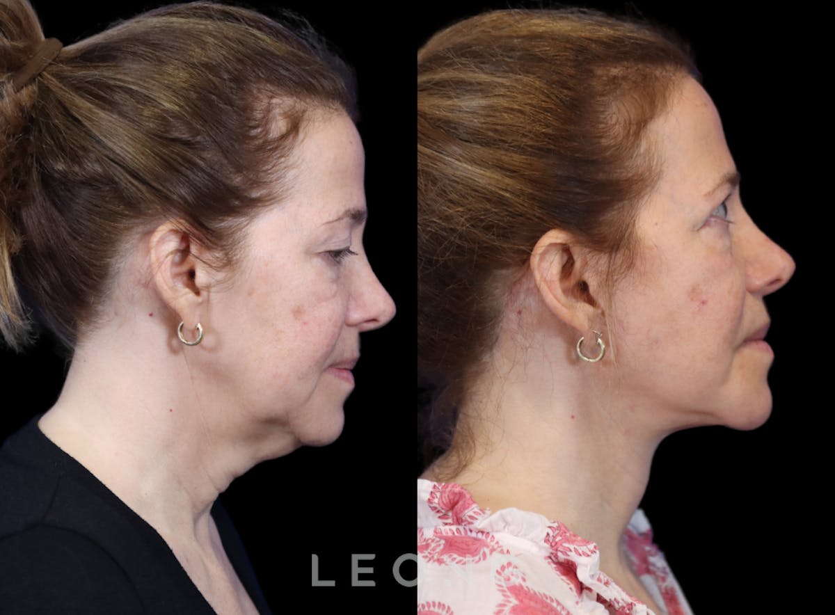 Facelift Before & After Gallery - Patient 495050 - Image 5