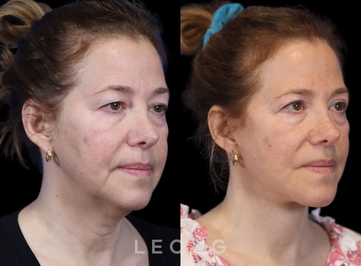 Facelift Before & After Gallery - Patient 495050 - Image 6