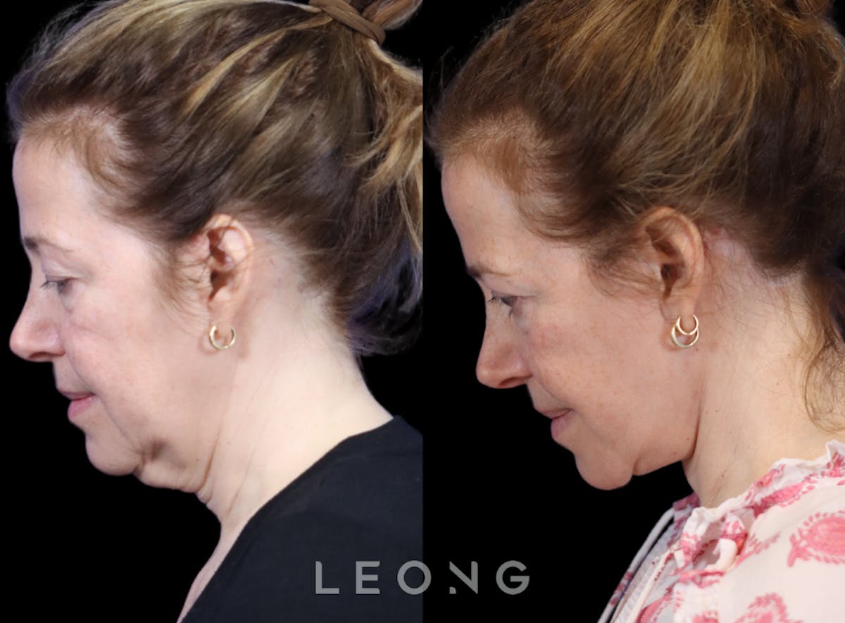Facelift Before & After Gallery - Patient 495050 - Image 3