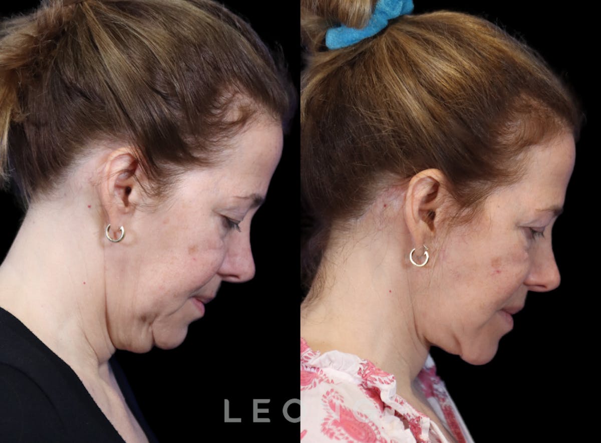 Facelift Before & After Gallery - Patient 495050 - Image 4