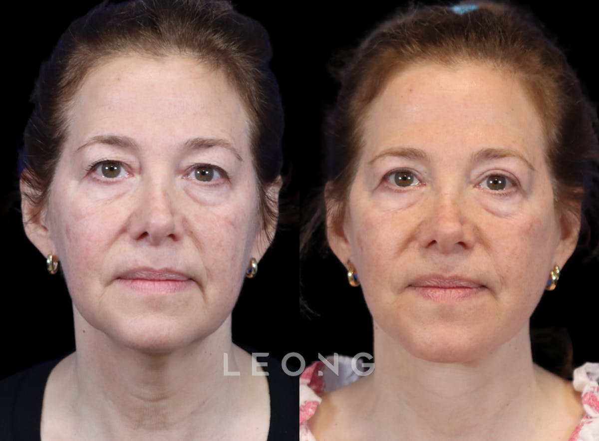 Facelift Before & After Gallery - Patient 495050 - Image 1