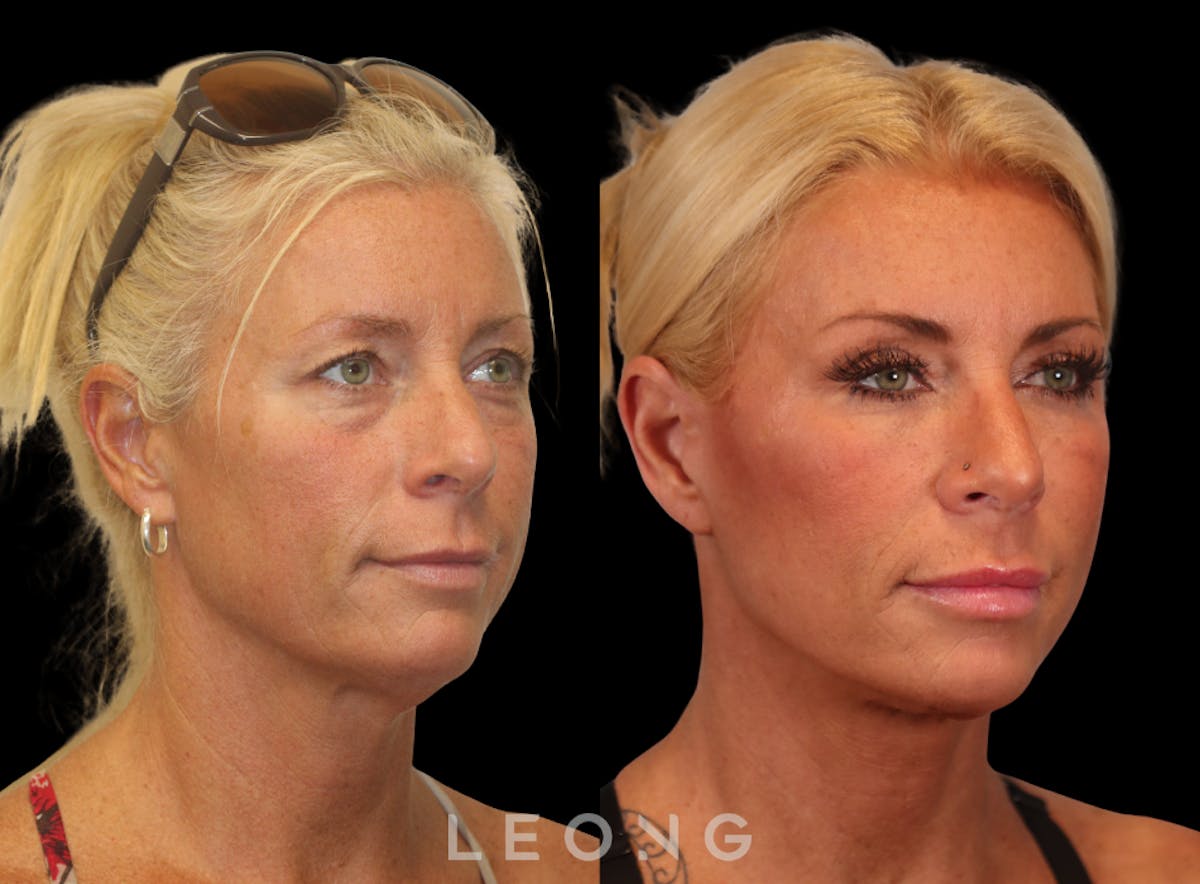 Facelift Before & After Gallery - Patient 146720 - Image 5