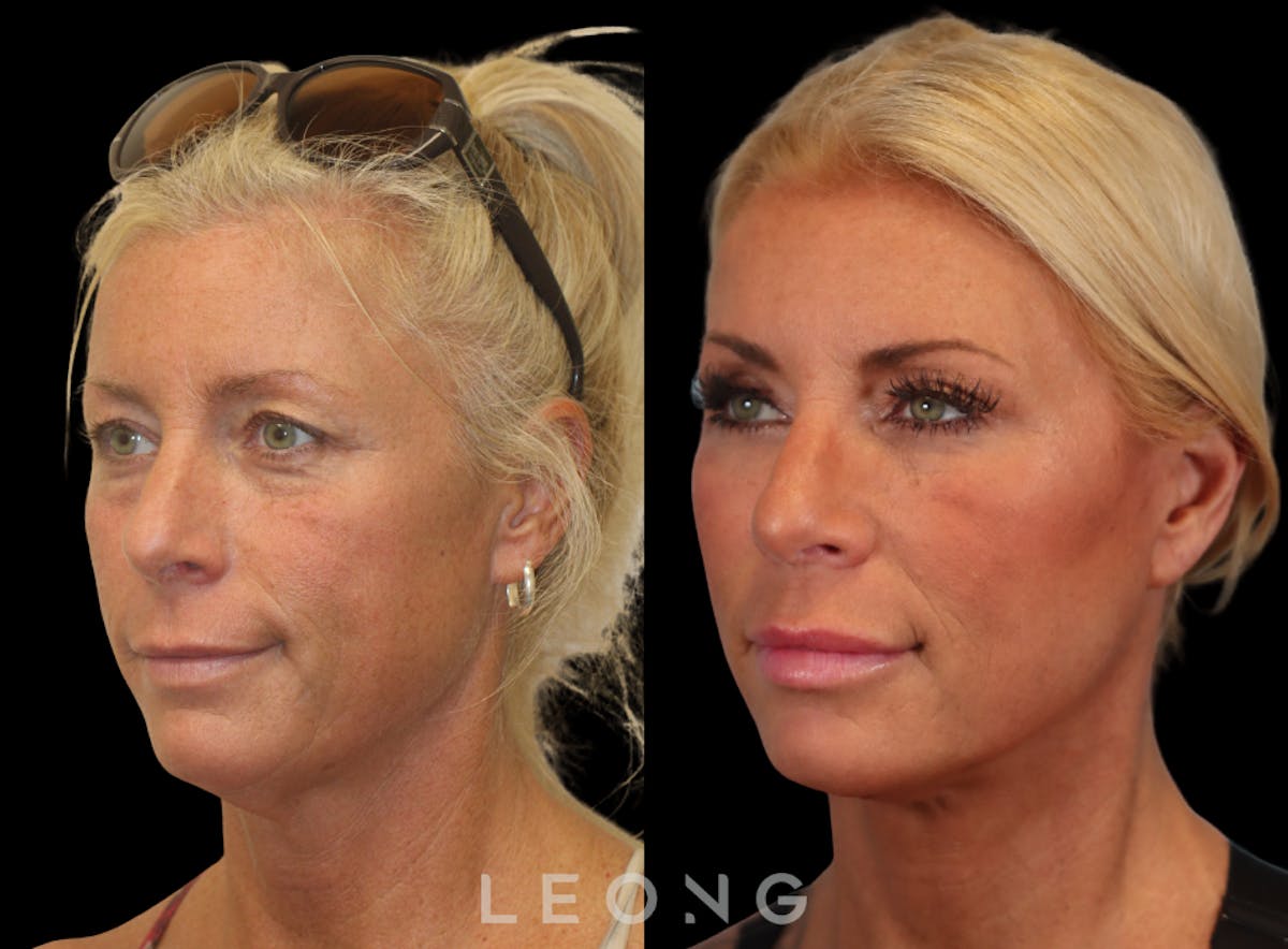 Facelift Before & After Gallery - Patient 146720 - Image 4