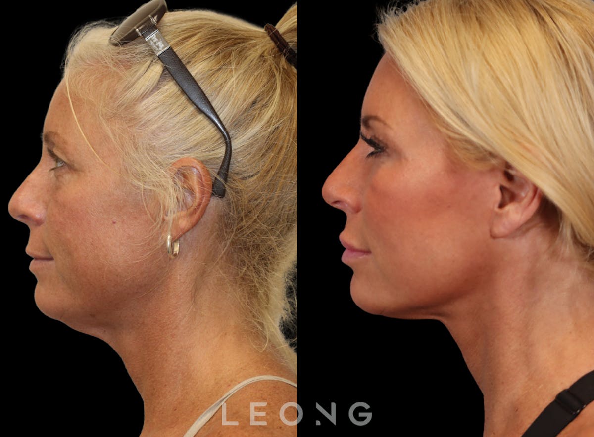 Facelift Before & After Gallery - Patient 146720 - Image 2