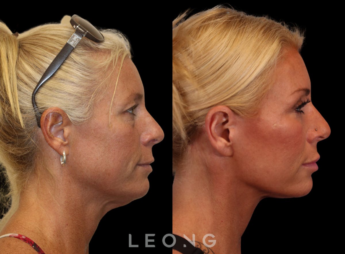 Facelift Before & After Gallery - Patient 146720 - Image 3