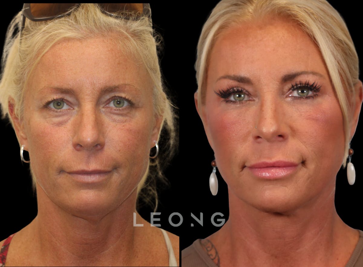 Facelift Before & After Gallery - Patient 146720 - Image 1