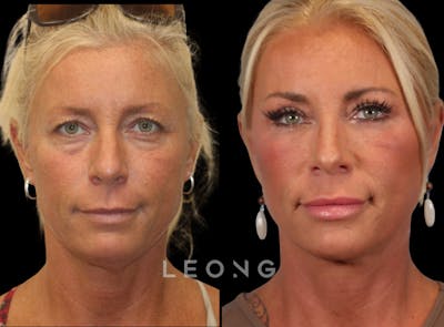 Facelift Before & After Gallery - Patient 146720 - Image 1