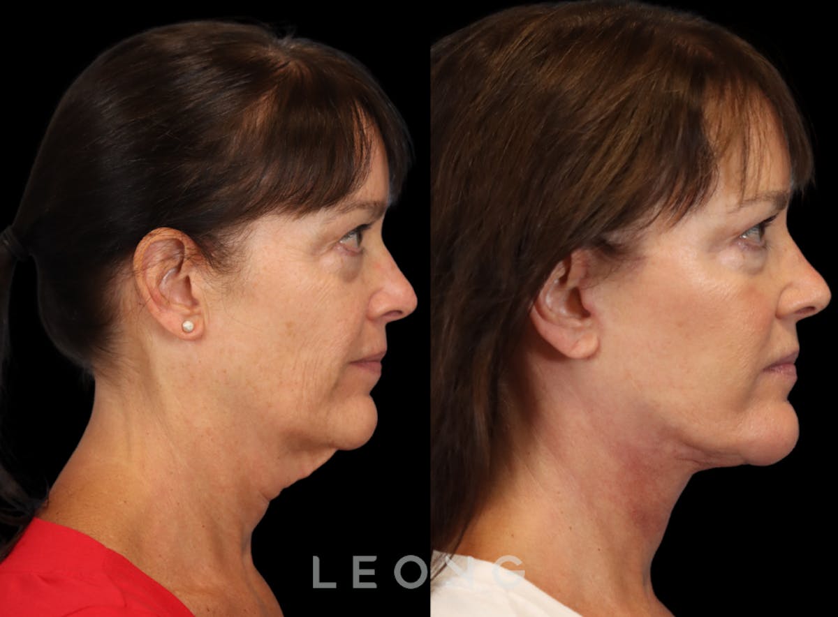 Facelift Before & After Gallery - Patient 197168 - Image 5