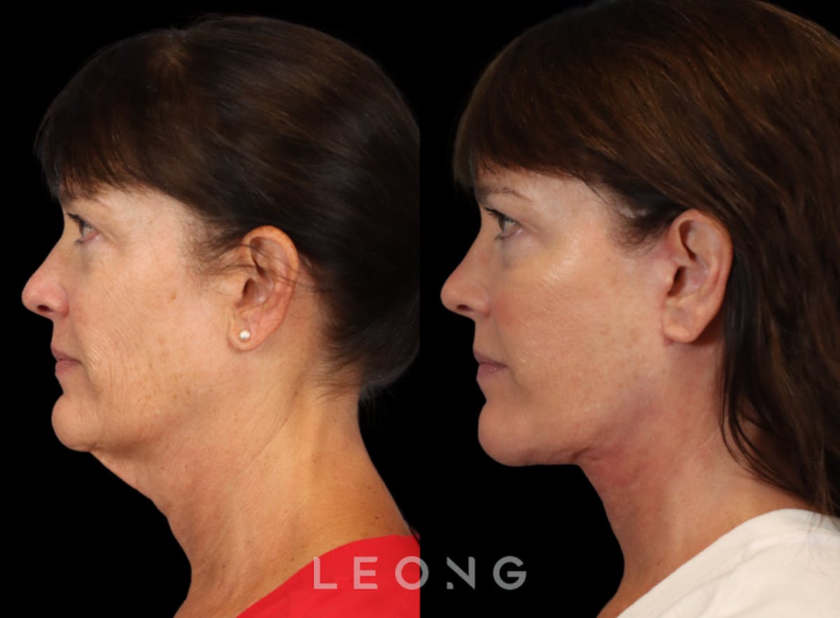 Facelift Before & After Gallery - Patient 197168 - Image 6