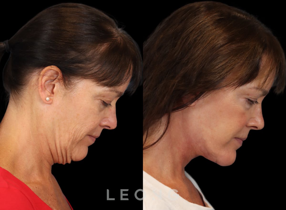Facelift Before & After Gallery - Patient 197168 - Image 4
