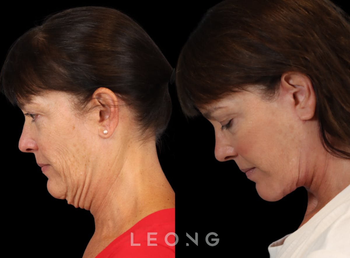 Facelift Before & After Gallery - Patient 197168 - Image 3