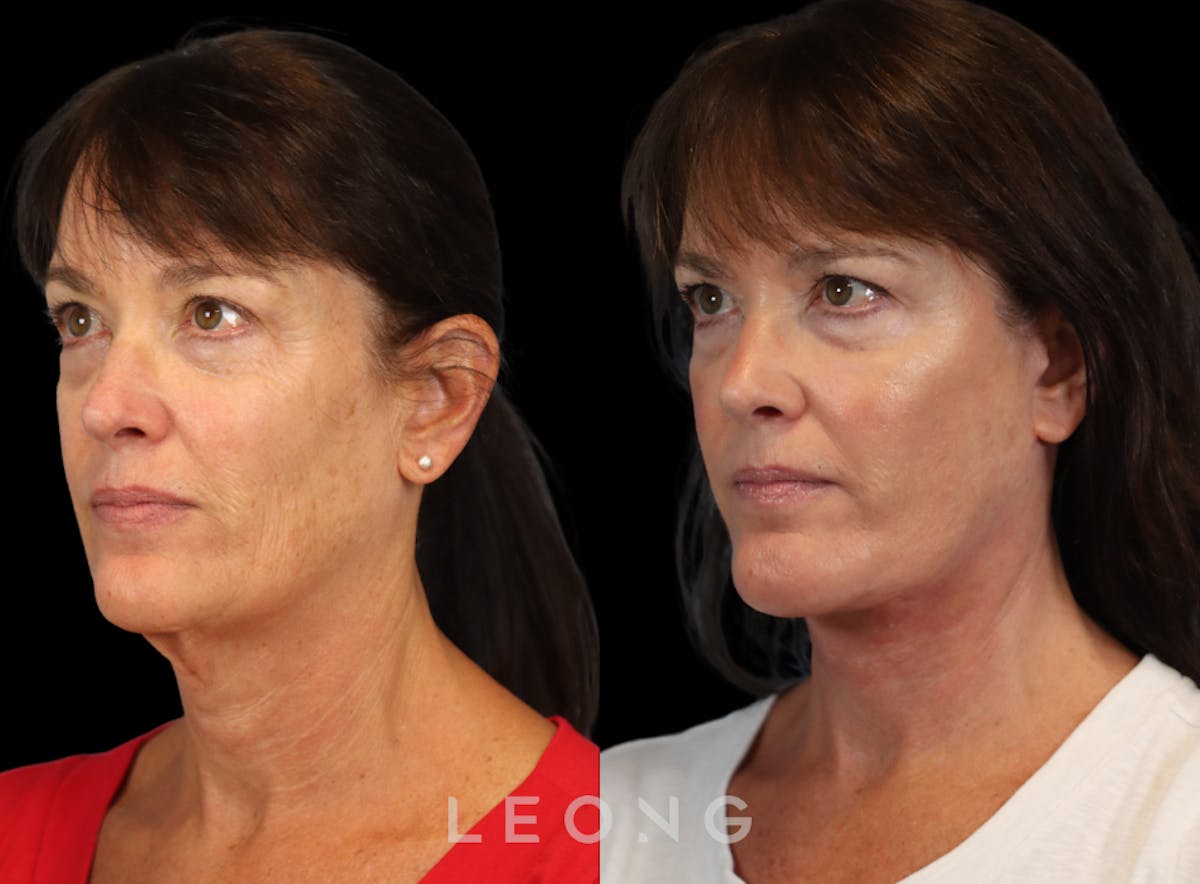 Facelift Before & After Gallery - Patient 197168 - Image 7