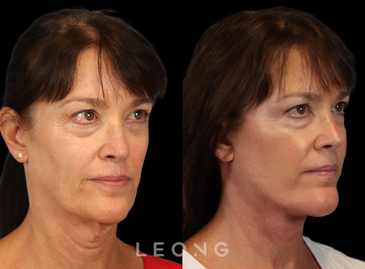 Facelift Before & After Gallery - Patient 197168 - Image 8