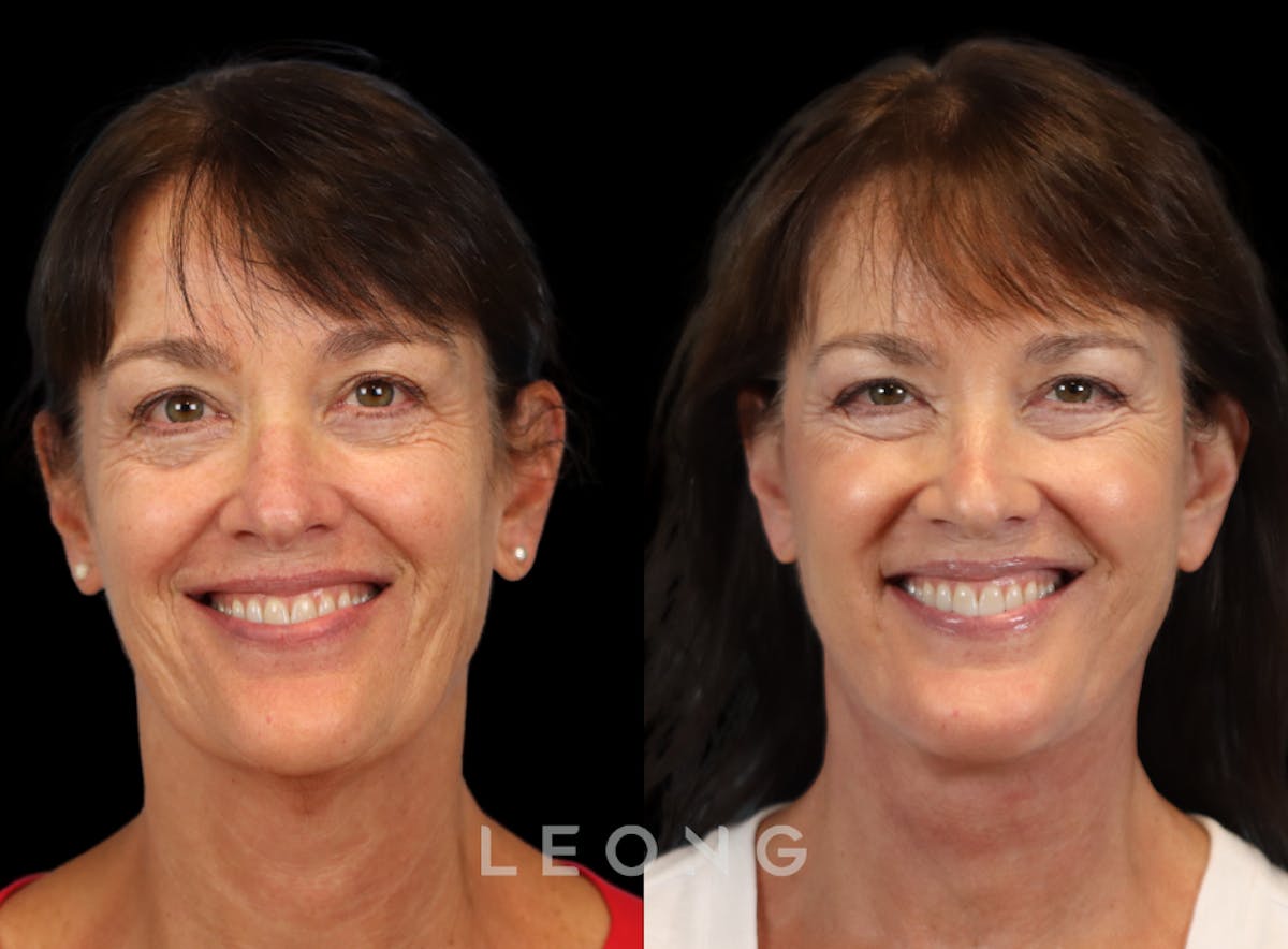 Facelift Before & After Gallery - Patient 197168 - Image 2