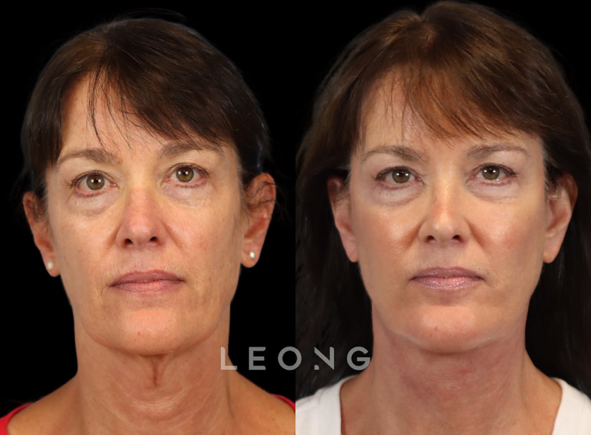 Facelift Before & After Gallery - Patient 197168 - Image 1