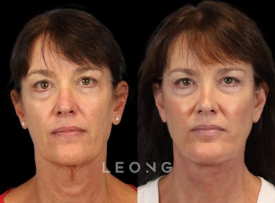 Facelift Before & After Gallery - Patient 197168 - Image 1
