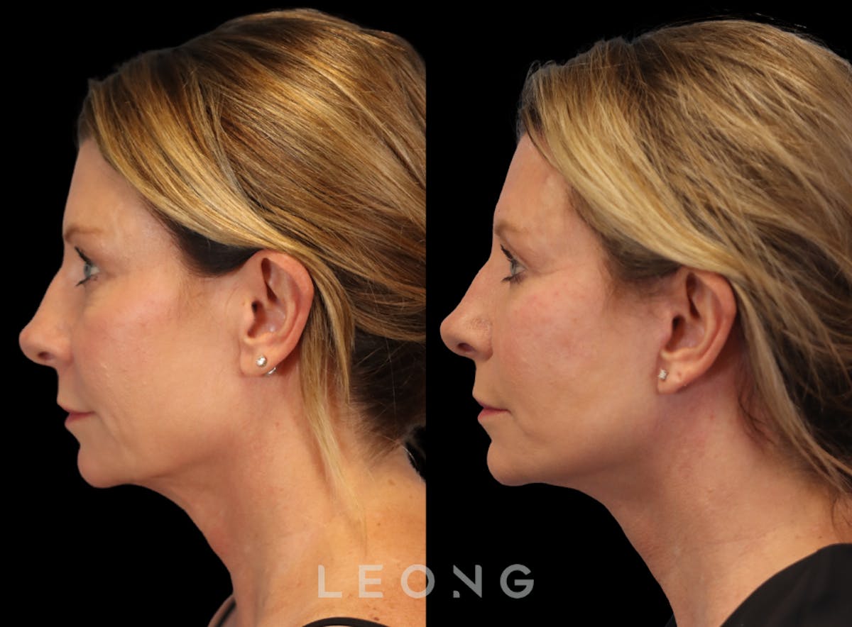Facelift Before & After Gallery - Patient 105448 - Image 3