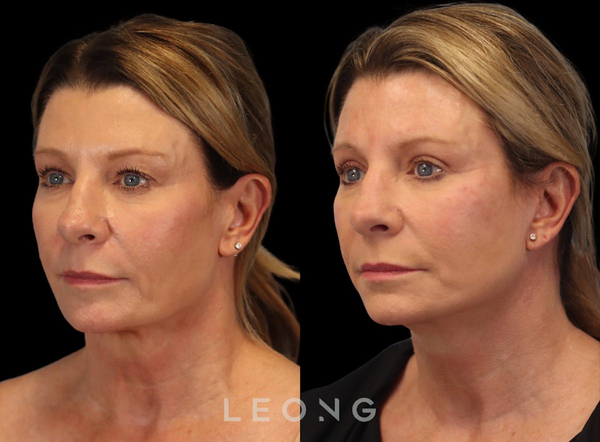 Facelift Before & After Gallery - Patient 105448 - Image 5