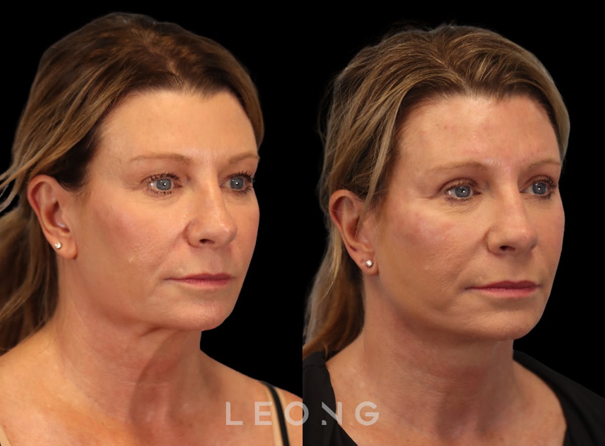 Facelift Before & After Gallery - Patient 105448 - Image 4