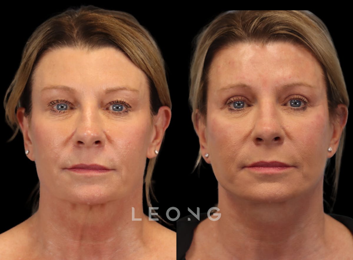 Facelift Before & After Gallery - Patient 105448 - Image 1
