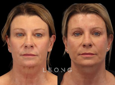 Facelift Before & After Gallery - Patient 105448 - Image 1