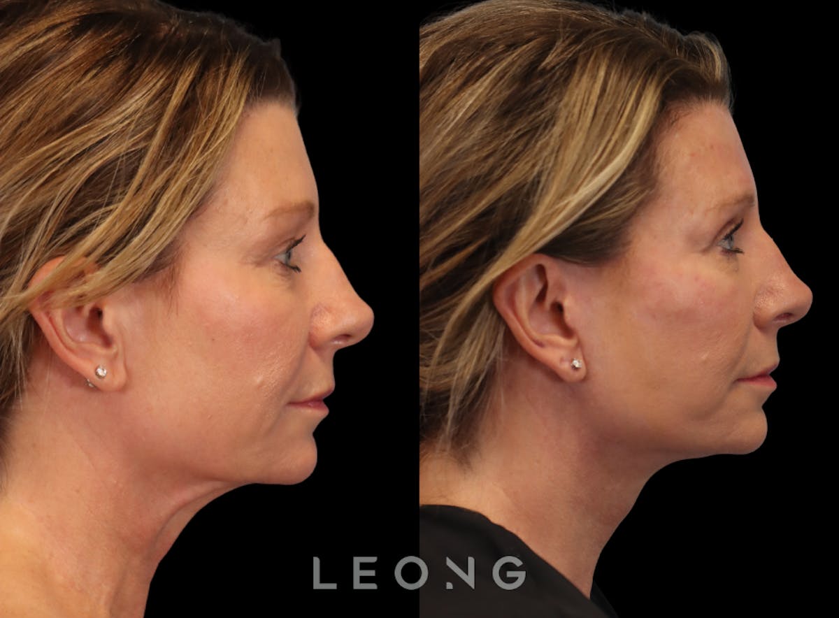 Facelift Before & After Gallery - Patient 105448 - Image 2