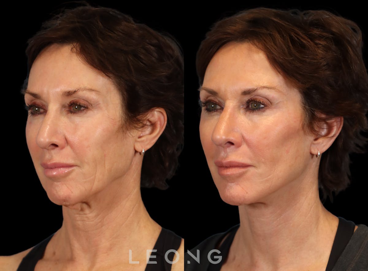 Facelift Before & After Gallery - Patient 304942 - Image 6
