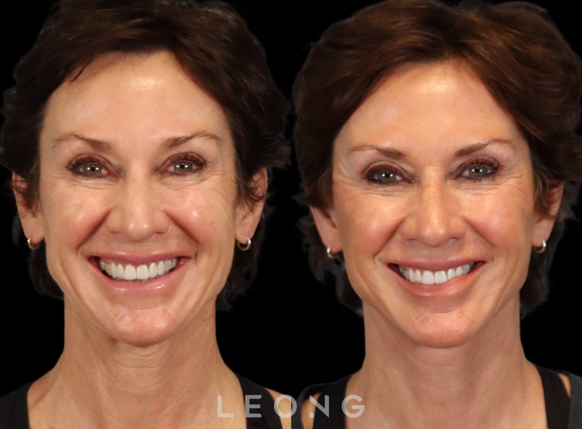Facelift Before & After Gallery - Patient 304942 - Image 4