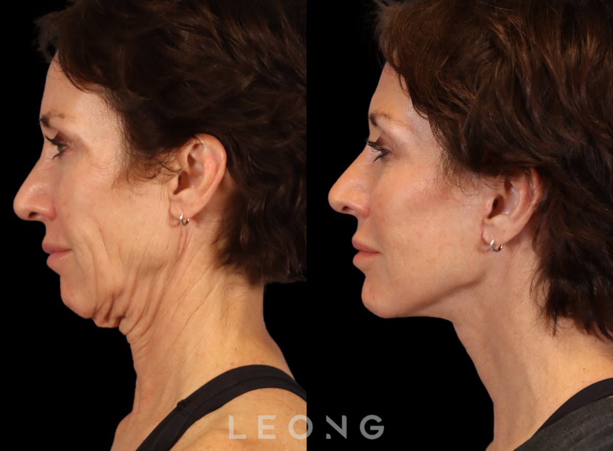 Facelift Before & After Gallery - Patient 304942 - Image 2