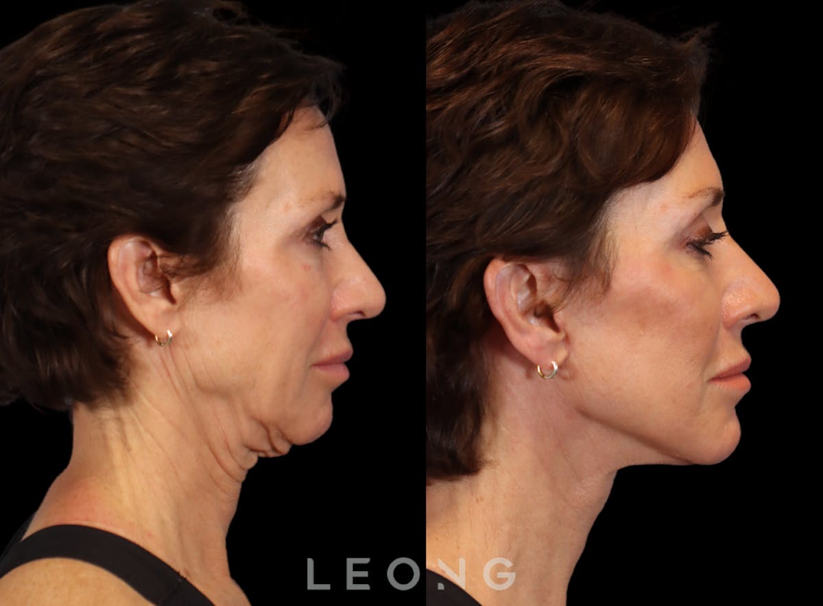 Facelift Before & After Gallery - Patient 304942 - Image 3