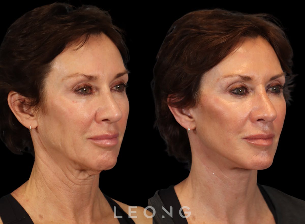 Facelift Before & After Gallery - Patient 304942 - Image 5