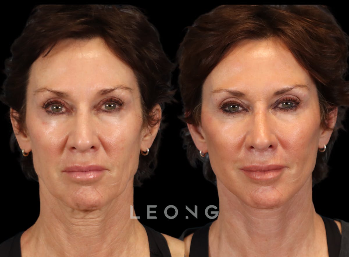 Facelift Before & After Gallery - Patient 304942 - Image 1