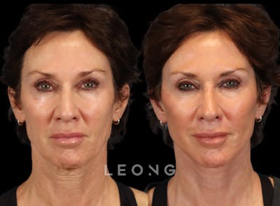 Facelift Before & After Gallery - Patient 304942 - Image 1