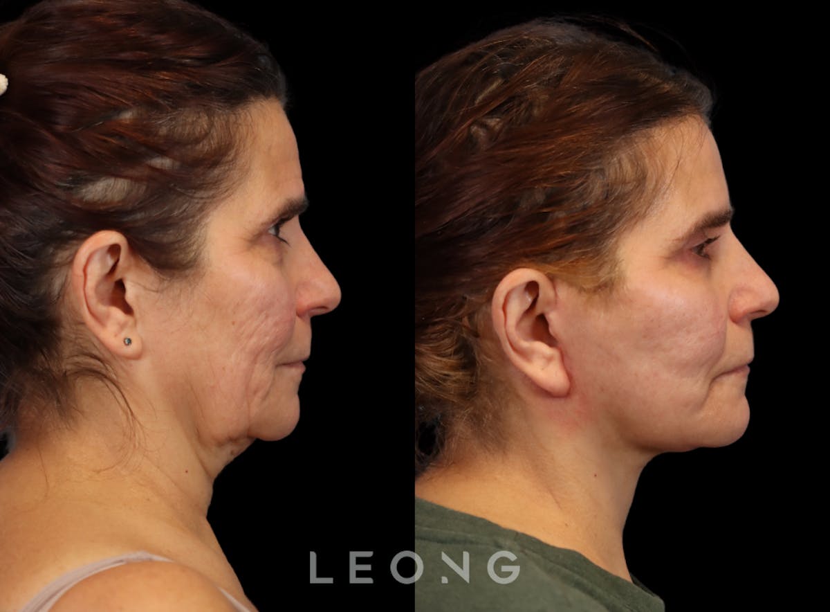 Facelift Before & After Gallery - Patient 175155 - Image 4