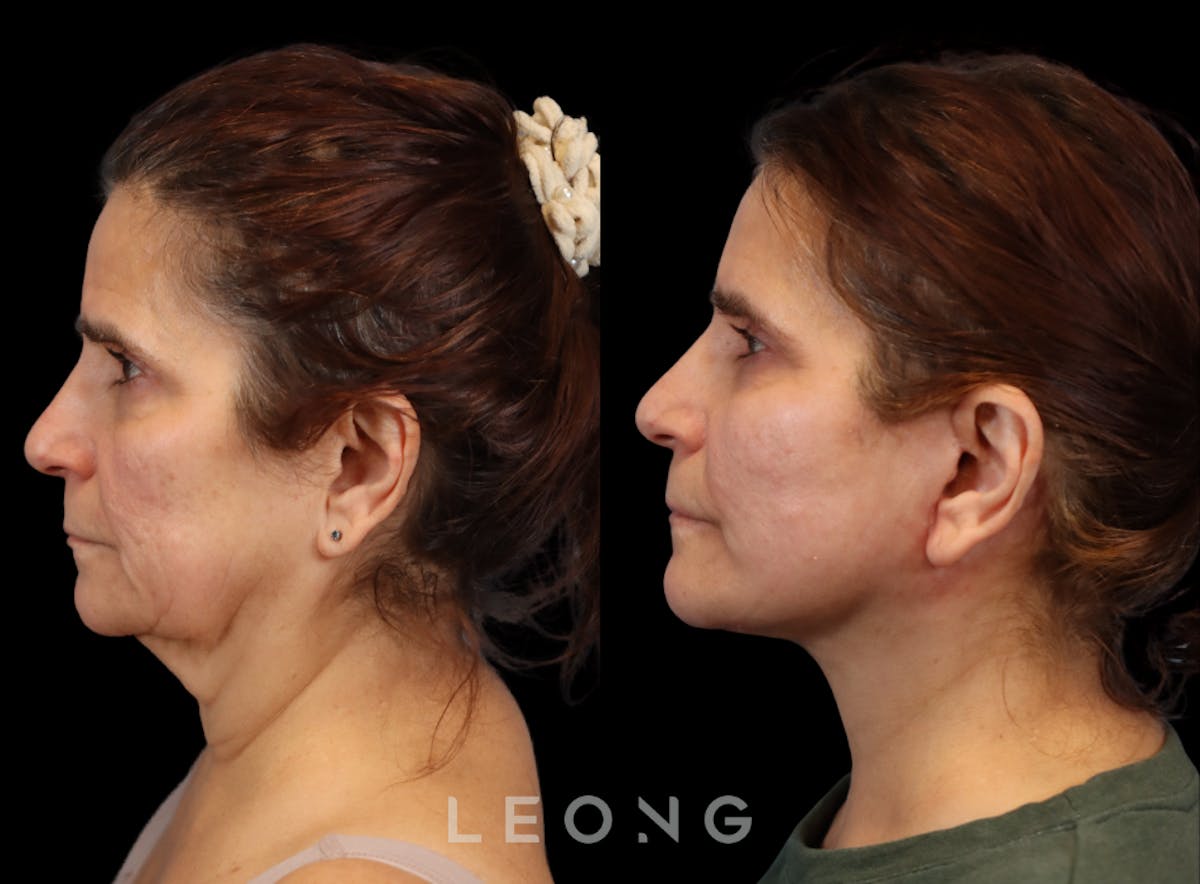 Facelift Before & After Gallery - Patient 175155 - Image 5