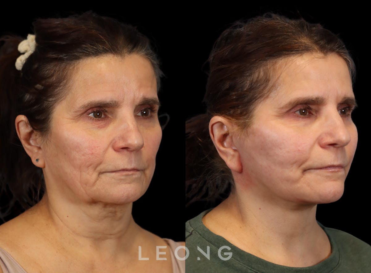 Facelift Before & After Gallery - Patient 175155 - Image 3