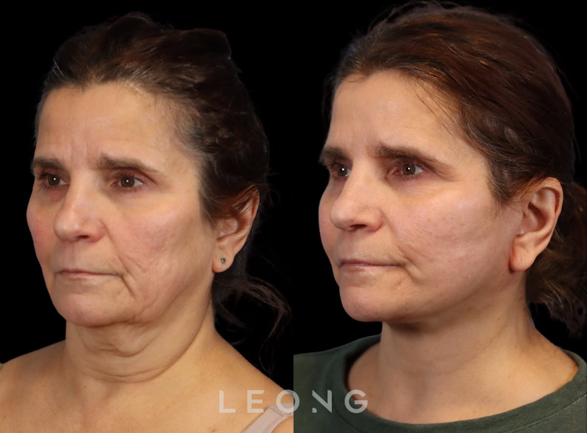 Facelift Before & After Gallery - Patient 175155 - Image 2