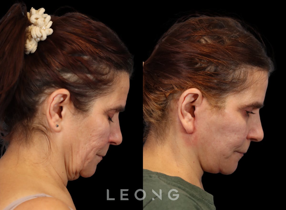 Facelift Before & After Gallery - Patient 175155 - Image 6