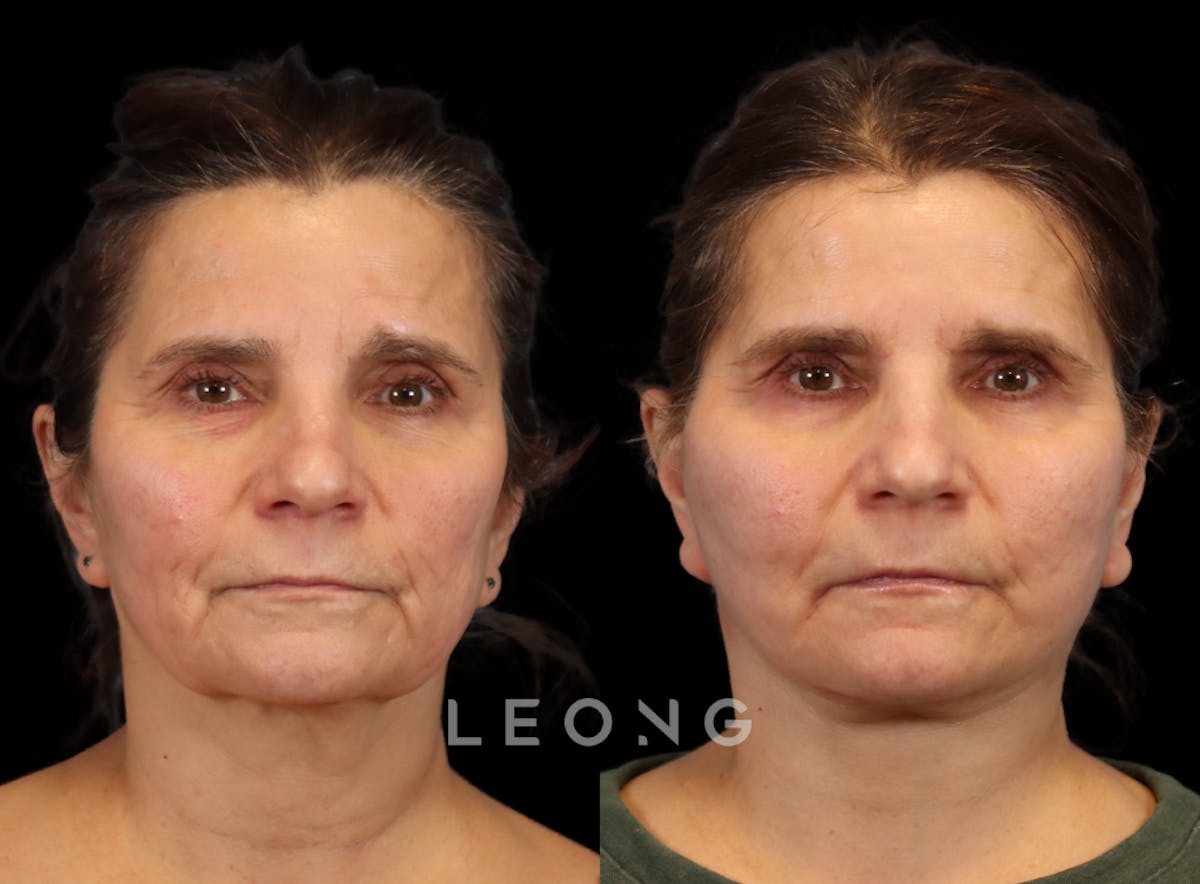 Facelift Before & After Gallery - Patient 175155 - Image 1