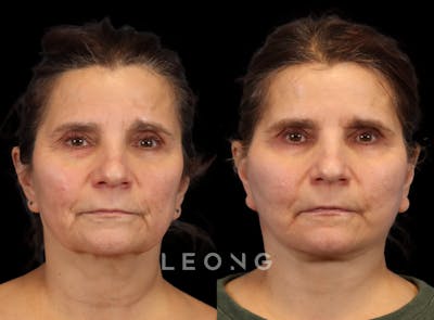 Facelift Before & After Gallery - Patient 175155 - Image 1