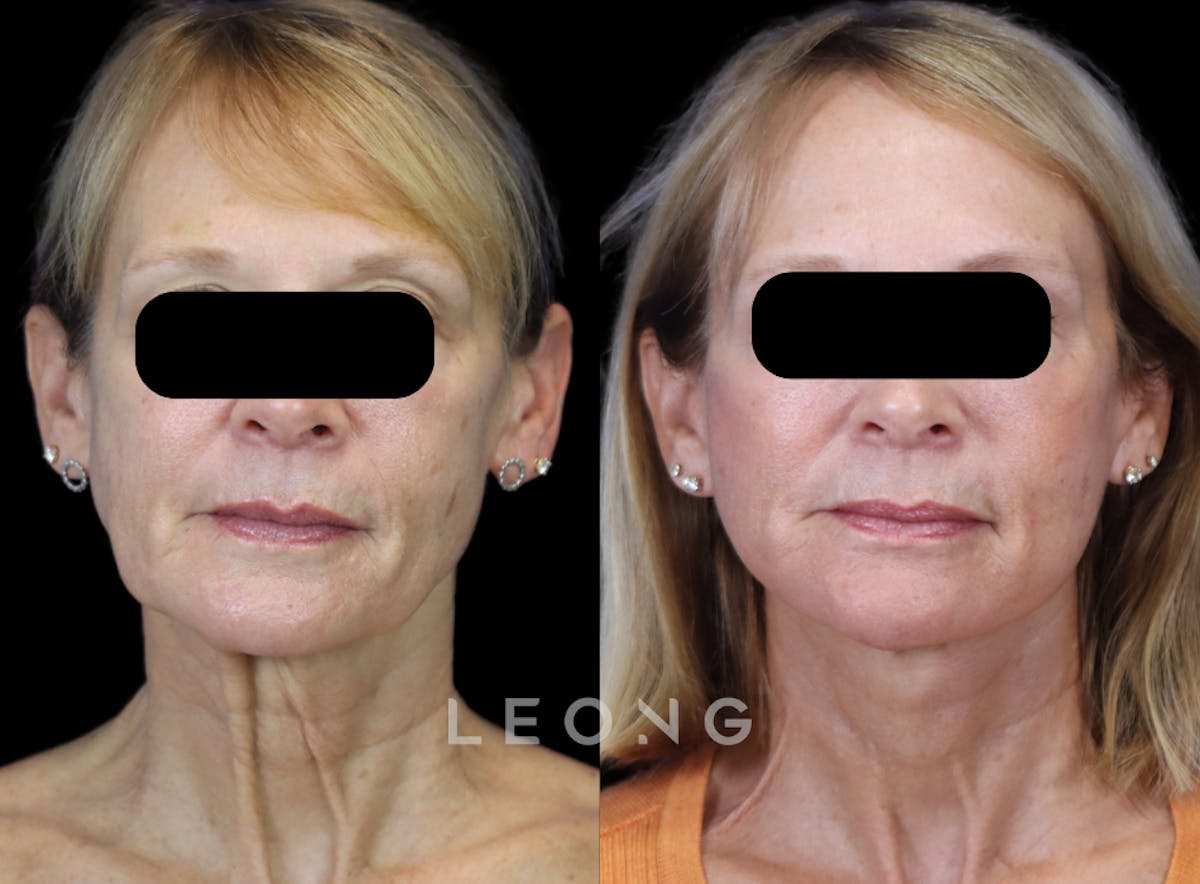 Facelift Before & After Gallery - Patient 301107 - Image 1