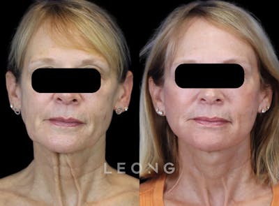 Facelift Before & After Gallery - Patient 301107 - Image 1