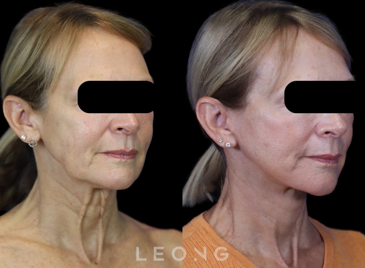 Facelift Before & After Gallery - Patient 301107 - Image 3