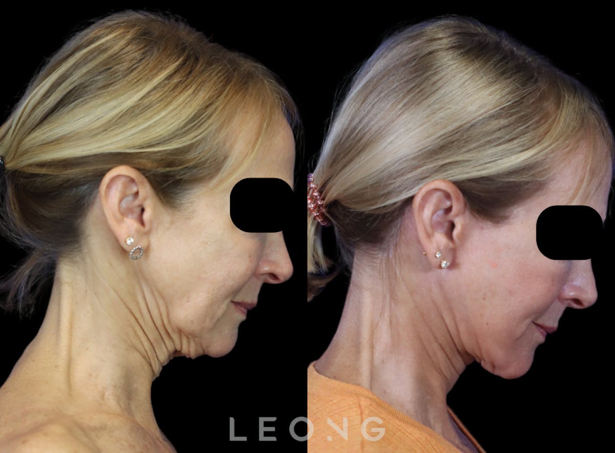 Facelift Before & After Gallery - Patient 301107 - Image 8