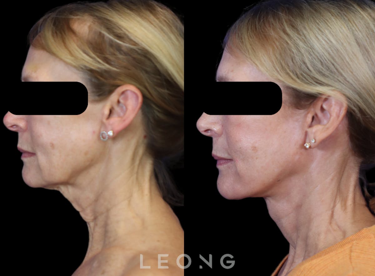 Facelift Before & After Gallery - Patient 301107 - Image 6