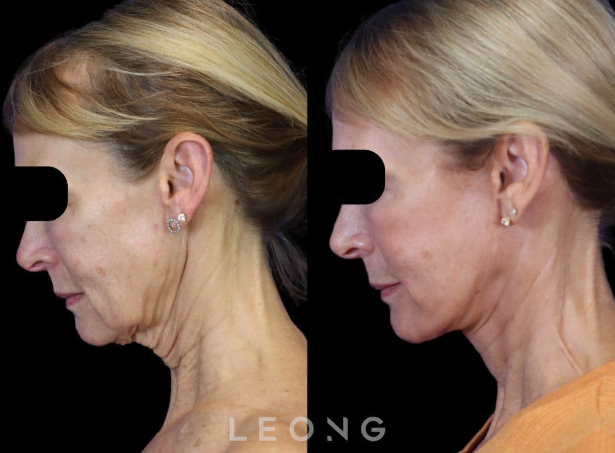 Facelift Before & After Gallery - Patient 301107 - Image 4
