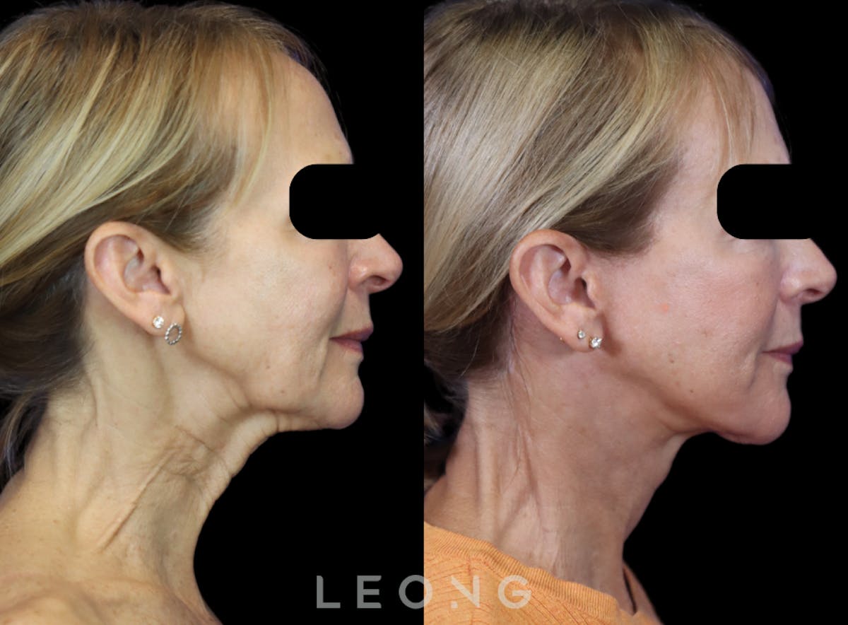 Facelift Before & After Gallery - Patient 301107 - Image 2