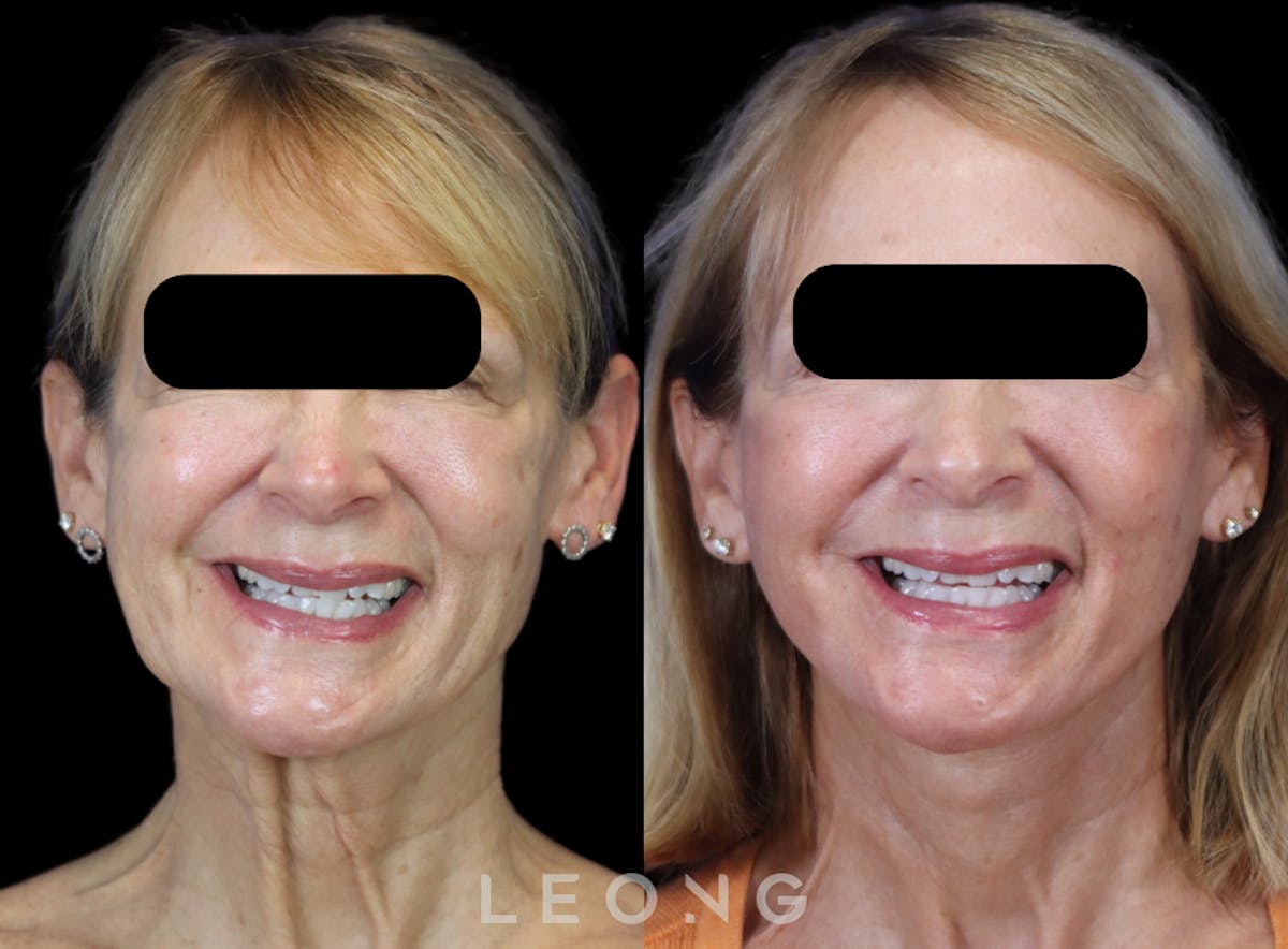 Facelift Before & After Gallery - Patient 301107 - Image 7